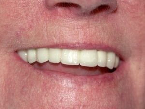 Lady Smiling after Having Dental Implants in Twickenham