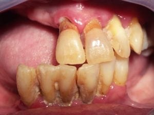 Teeth Before Dental Implant Placement