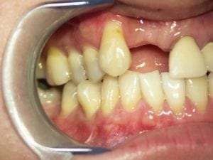 Teeth Before Dental Implant Placement in Twickenham