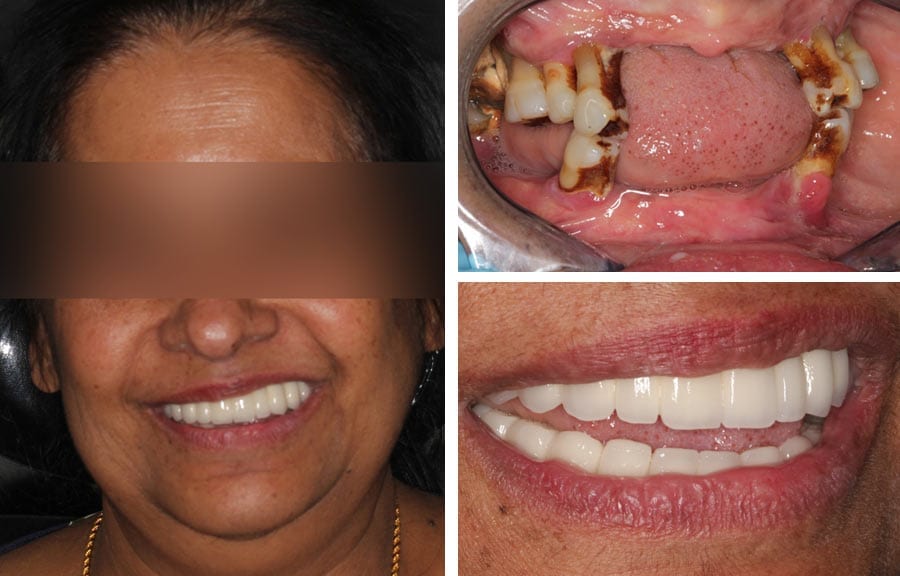 Asian Lady Showing Smile Before and After Implants at Soni Dental