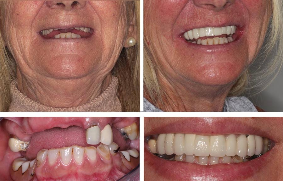 Lady Showing Smile Before and After Dental Implant Placement at Soni Dental
