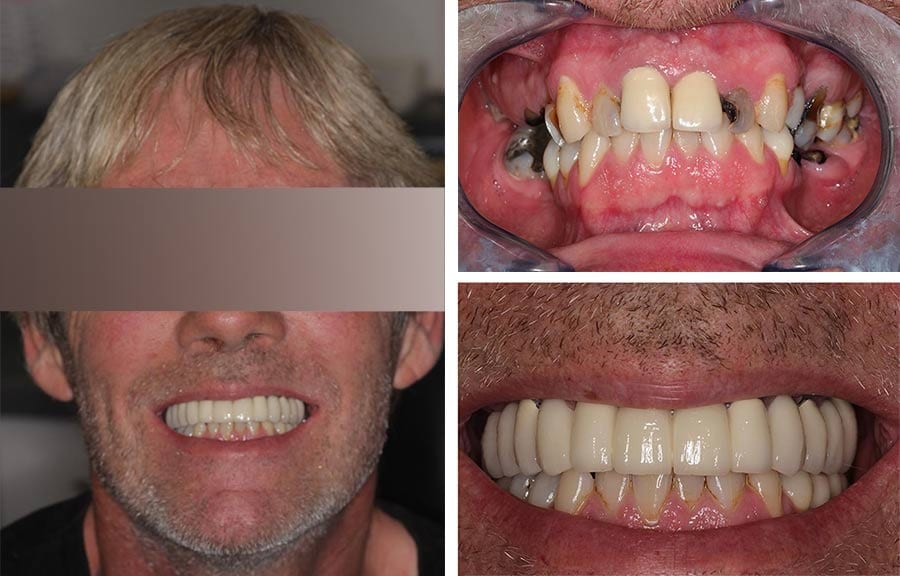 Patient Before and After Dental Implant Placement in Twickenham