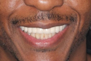 Man With Perfect Teeth After Dental Implants in Twickenham