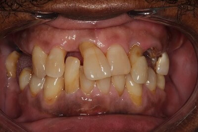 Man With Bad Teeth Before Dental Implants in Twickenham